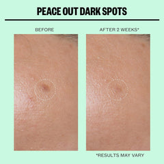 Peace Out- Dark Spots Micro Needling Dots