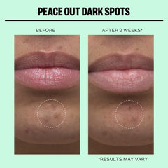 Peace Out- Dark Spots Micro Needling Dots