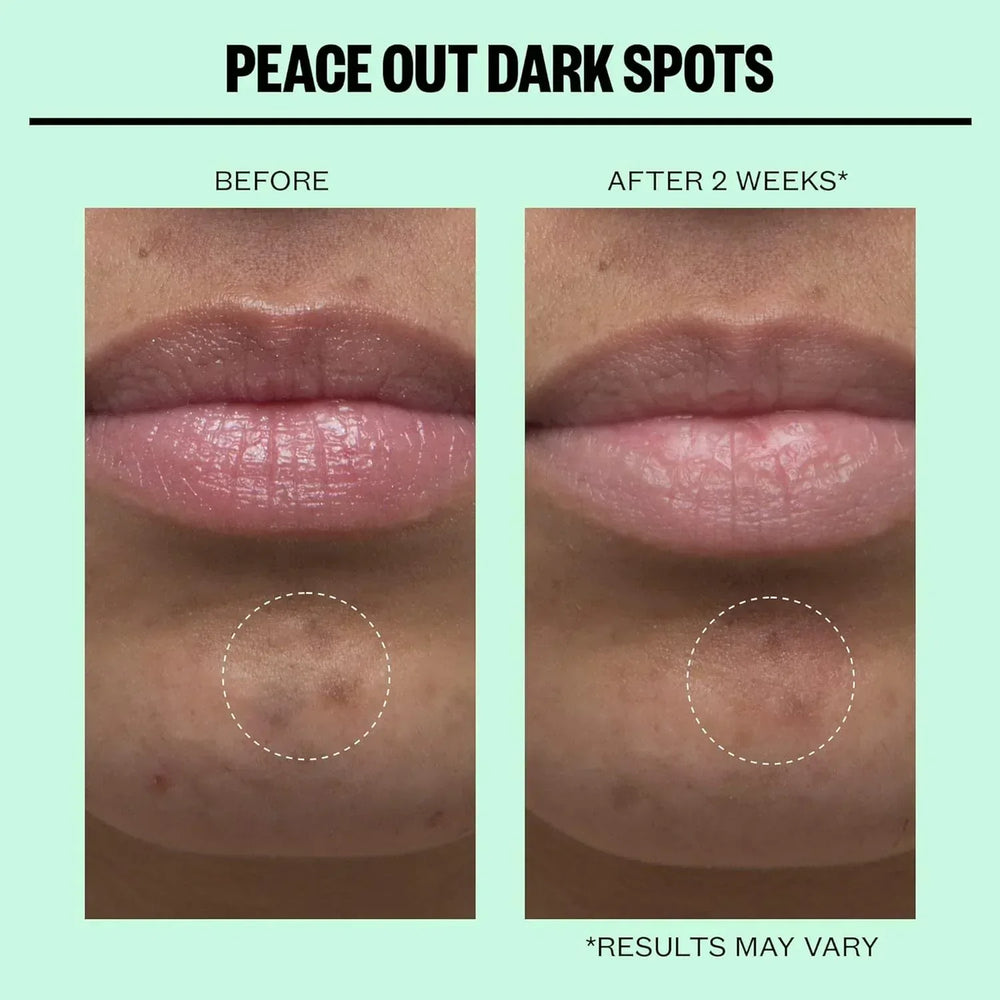 Peace Out- Dark Spots Micro Needling Dots - The Beauty League Pakistan
