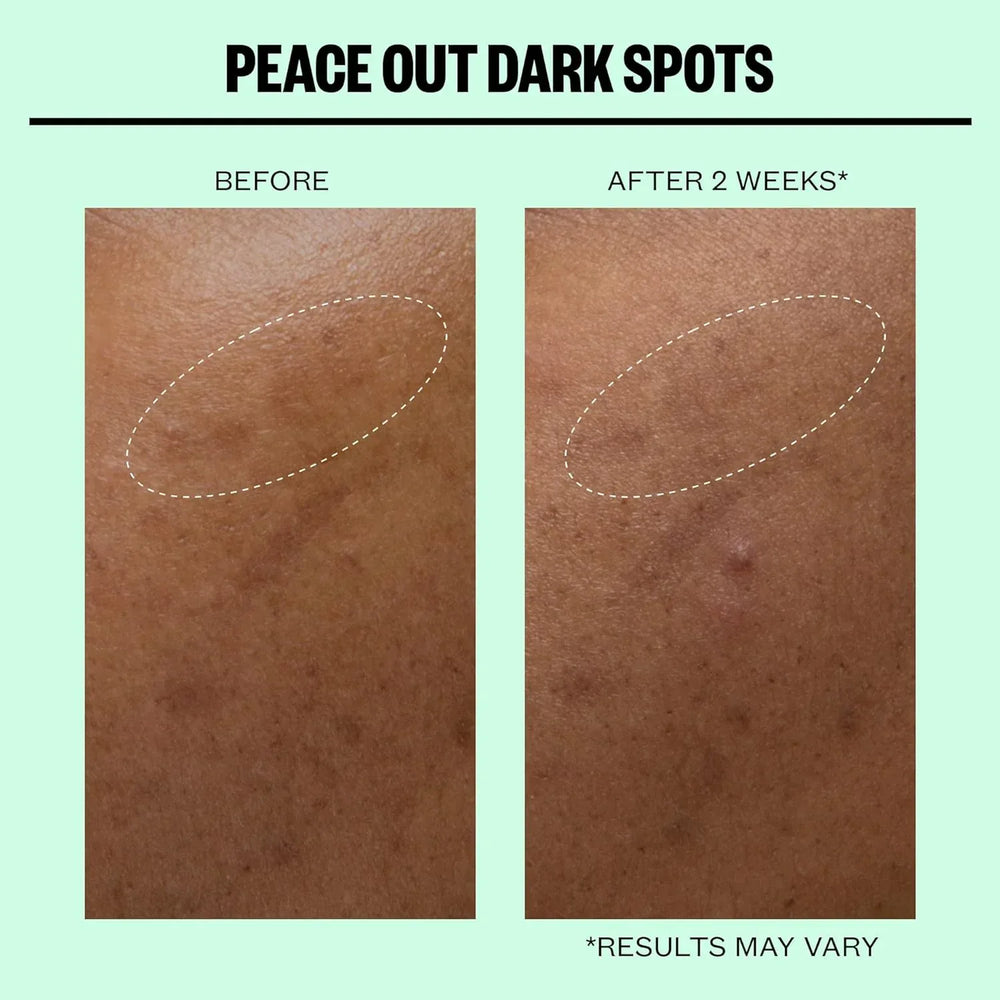 Peace Out- Dark Spots Micro Needling Dots - The Beauty League Pakistan